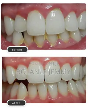 Dental Scaling and Polishing Service