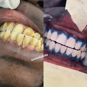 Sabis na Kwarewa na Kayan Gyaran Hakori daga SmilesByBella