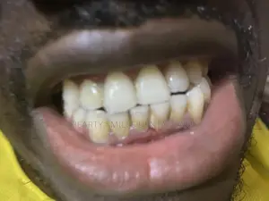 Professional Teeth Scaling & Whitening Service