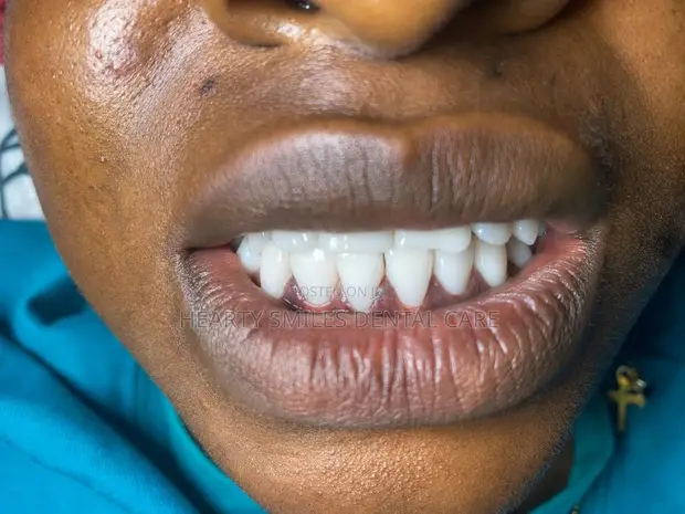 Professional Teeth Washing and Whitening - 1