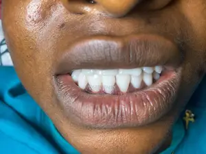 Professional Teeth Washing and Whitening