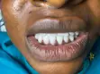 Professional Teeth Washing and Whitening - 1