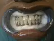 Professional Teeth Washing and Whitening - 2