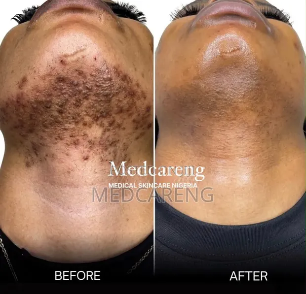 Laser Hair Removal Service - 1
