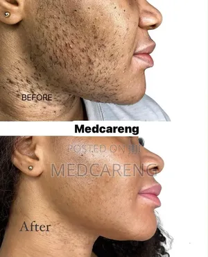 Laser Hair Removal Service