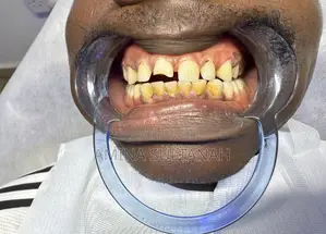 Teeth Scaling & Polishing by Sultanah Royale Beauty