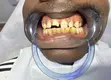 Teeth Scaling & Polishing by Sultanah Royale Beauty - 1