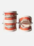Dental Orthodontic Teeth Model with Colorful Braces - 2