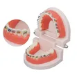 Dental Orthodontic Teeth Model with Colorful Braces - 5